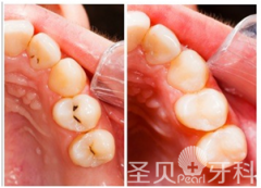 成都补龋齿要花多少钱？几百块够吗？